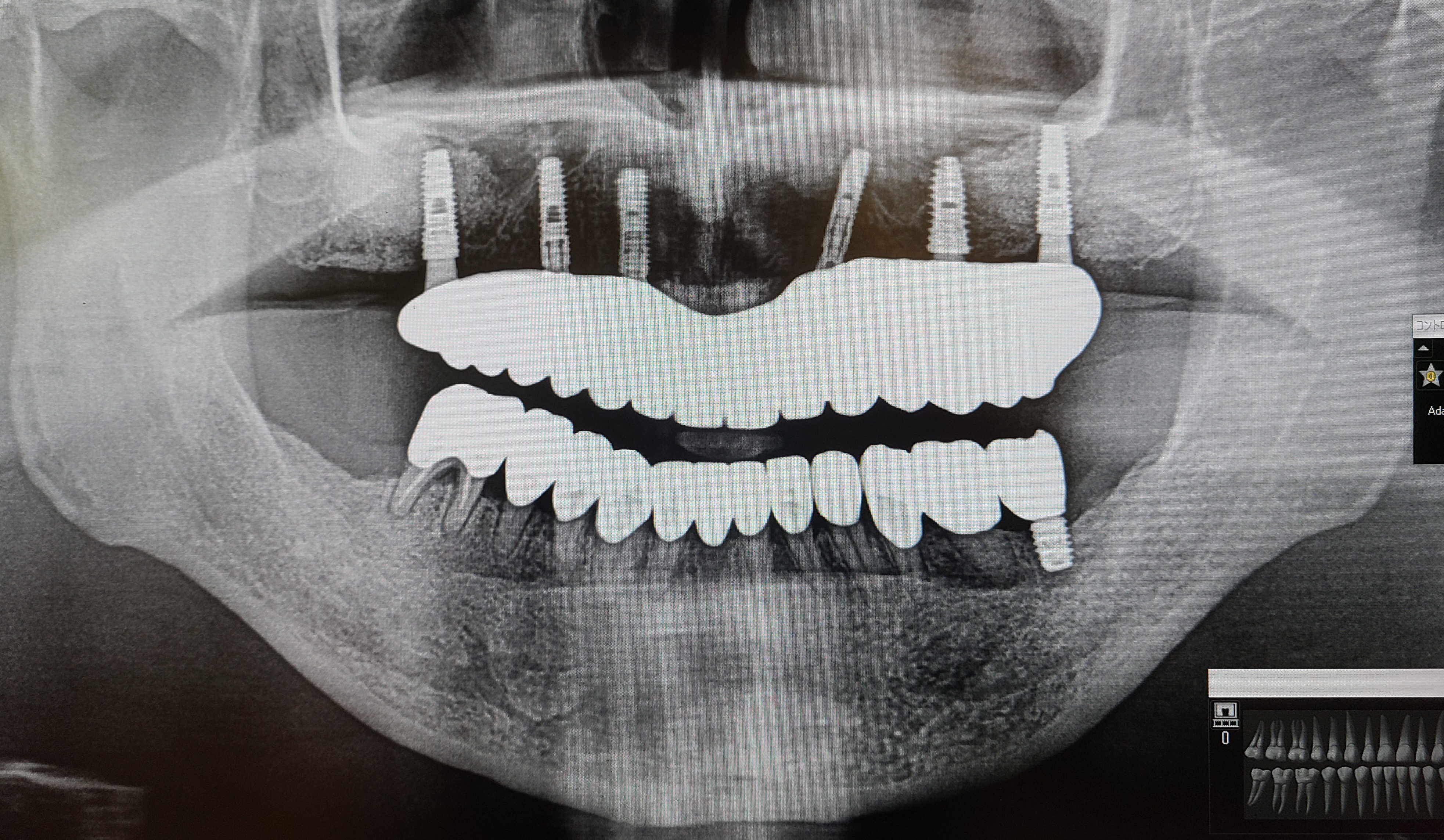 オールオンインプラント治療
                歯が虫歯でボロボロになってしまってすべての歯を抜歯しないといけない場合の治療方法です