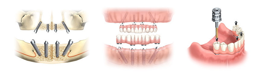 外れやすく食べにくい入れ歯から卒業