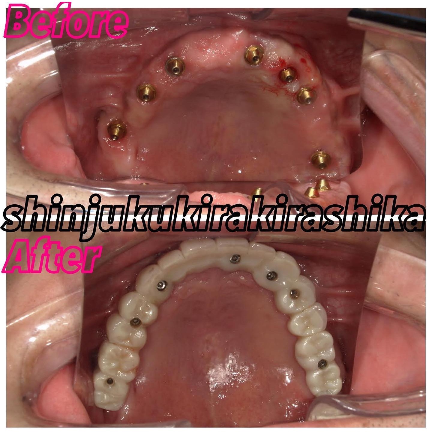 オールオン４，６治療 料金表