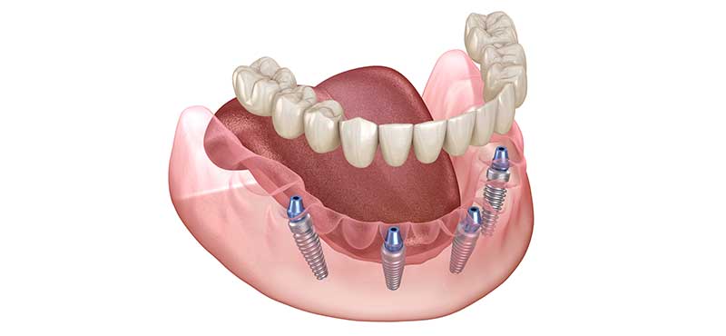 東京審美歯科　新宿きらきら歯科のオールオン4治療