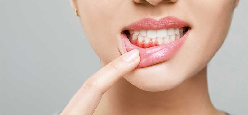 東京審美歯科　新宿きらきら歯科の食いしばり改善治療