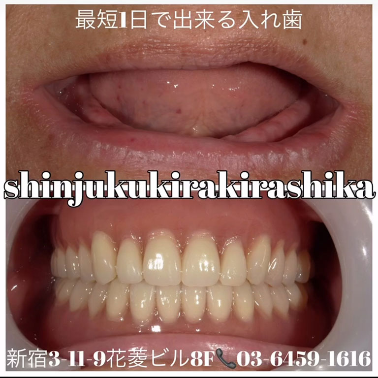 即日義歯