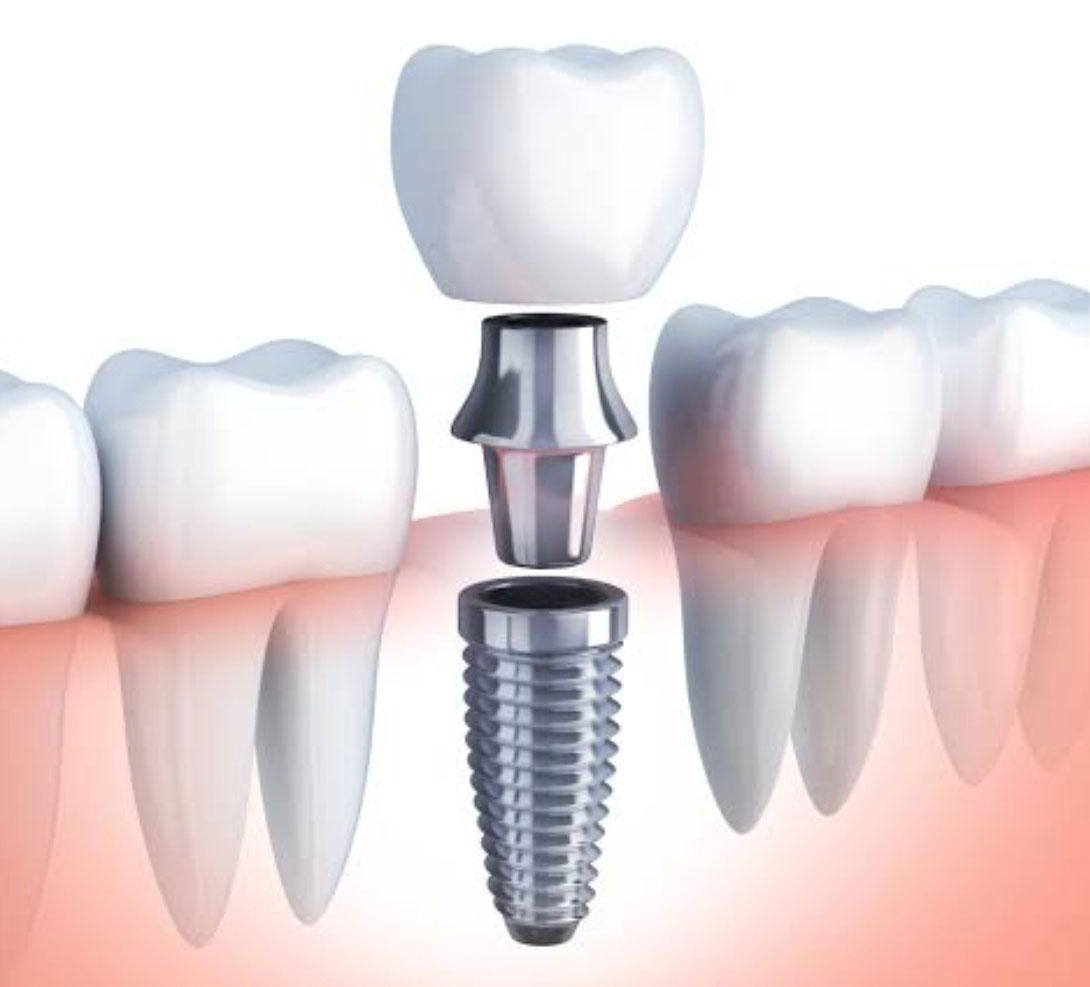 インプラント治療とは