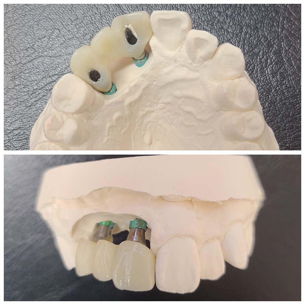 インプラントは「第３の歯」