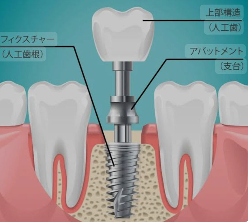 上部構造(人工歯)のジルコニアとは