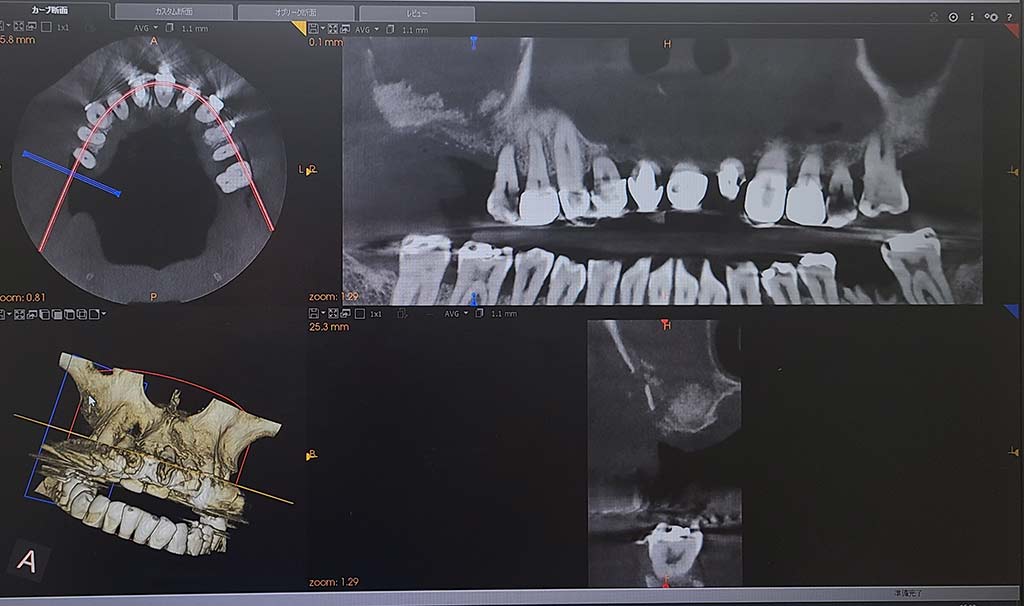 インプラント治療をするうえでまずはCTを撮影して骨があるかの確認をします