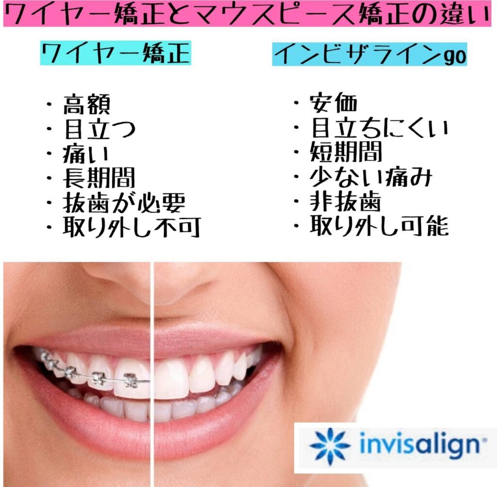 インビザラインについて