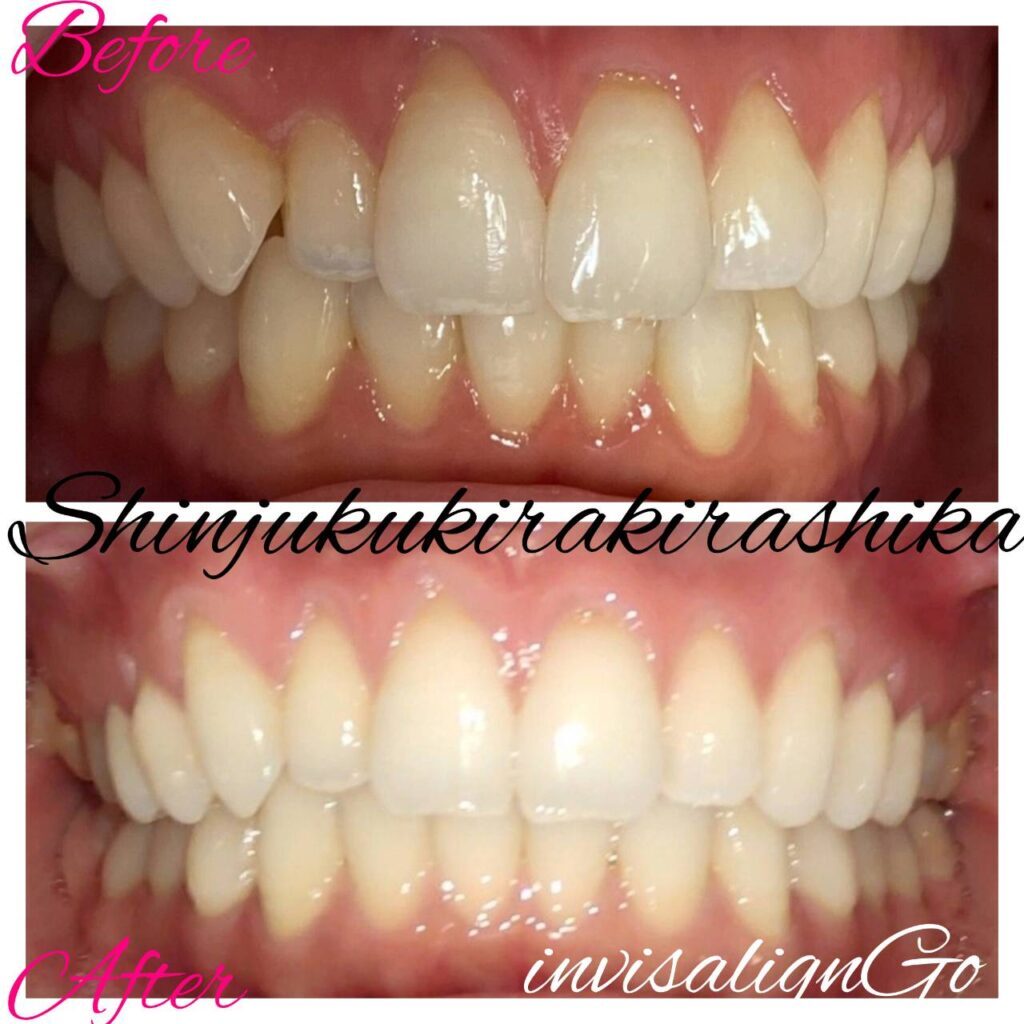 インビザラインgo症例