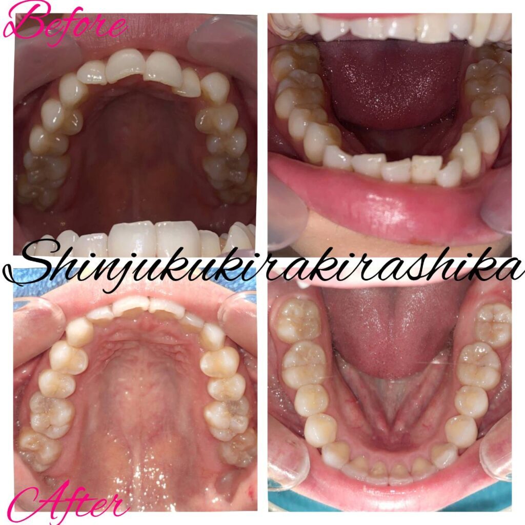 インビザラインgo症例