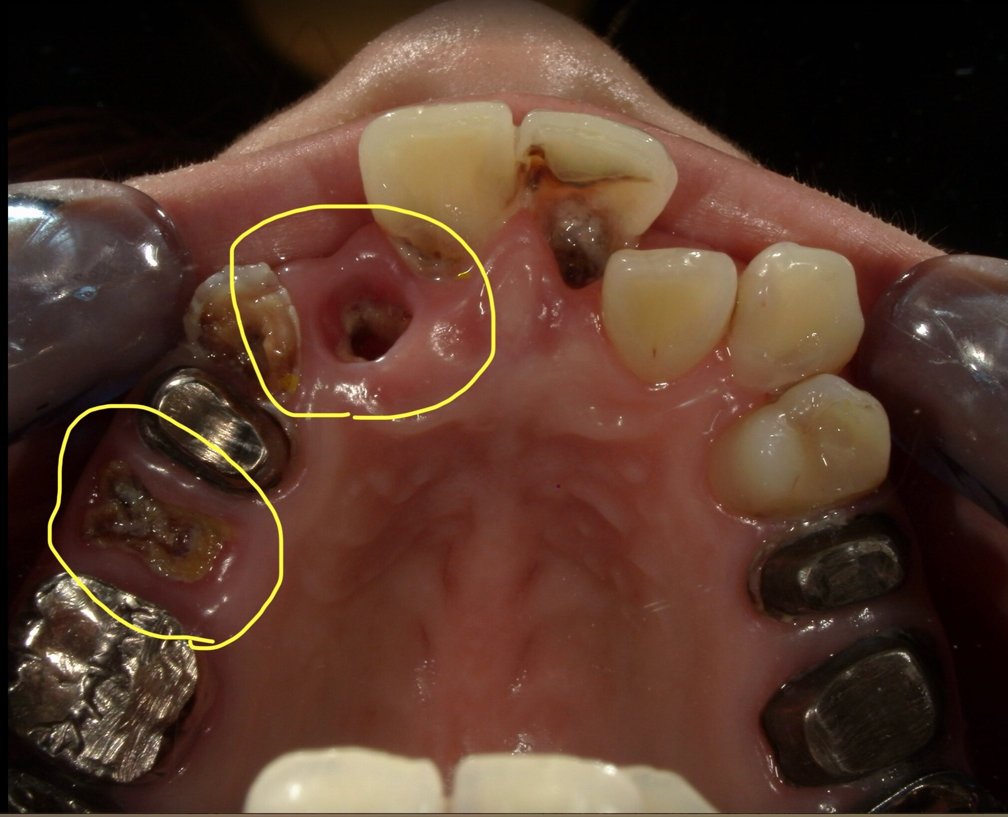 【歯科医師が解説】C4とは？歯のSOSサインを見逃さないで！
