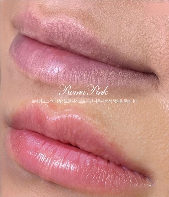 ローマピンク症例💋