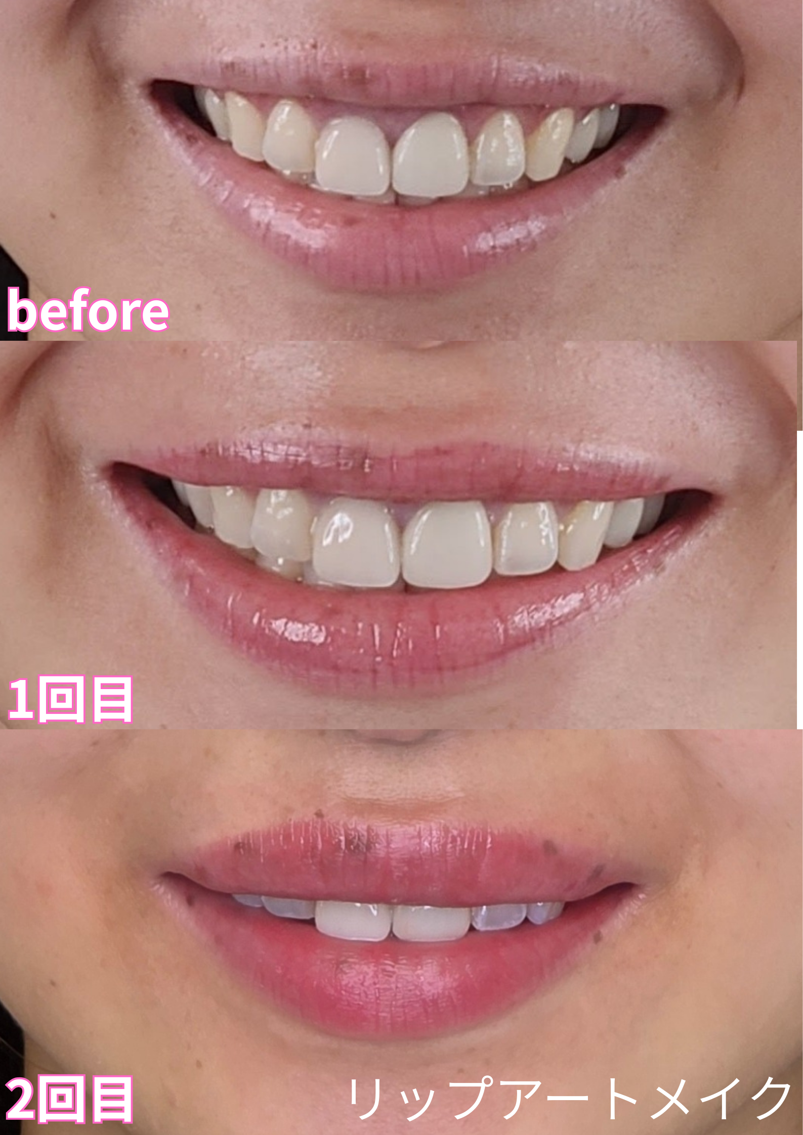 リップアートメイク症例💋