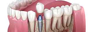 インプラント治療