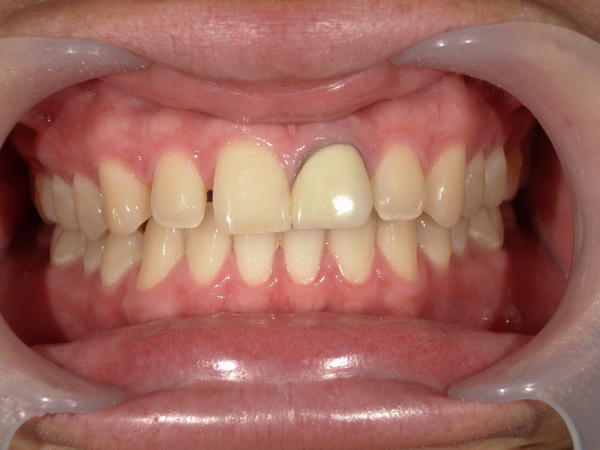 モニター患者様4