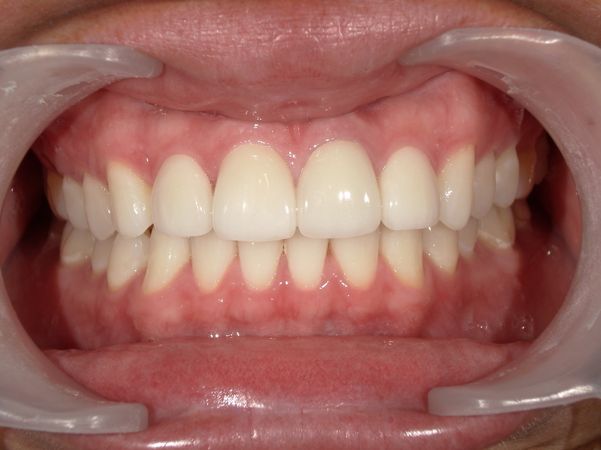 モニター患者様4