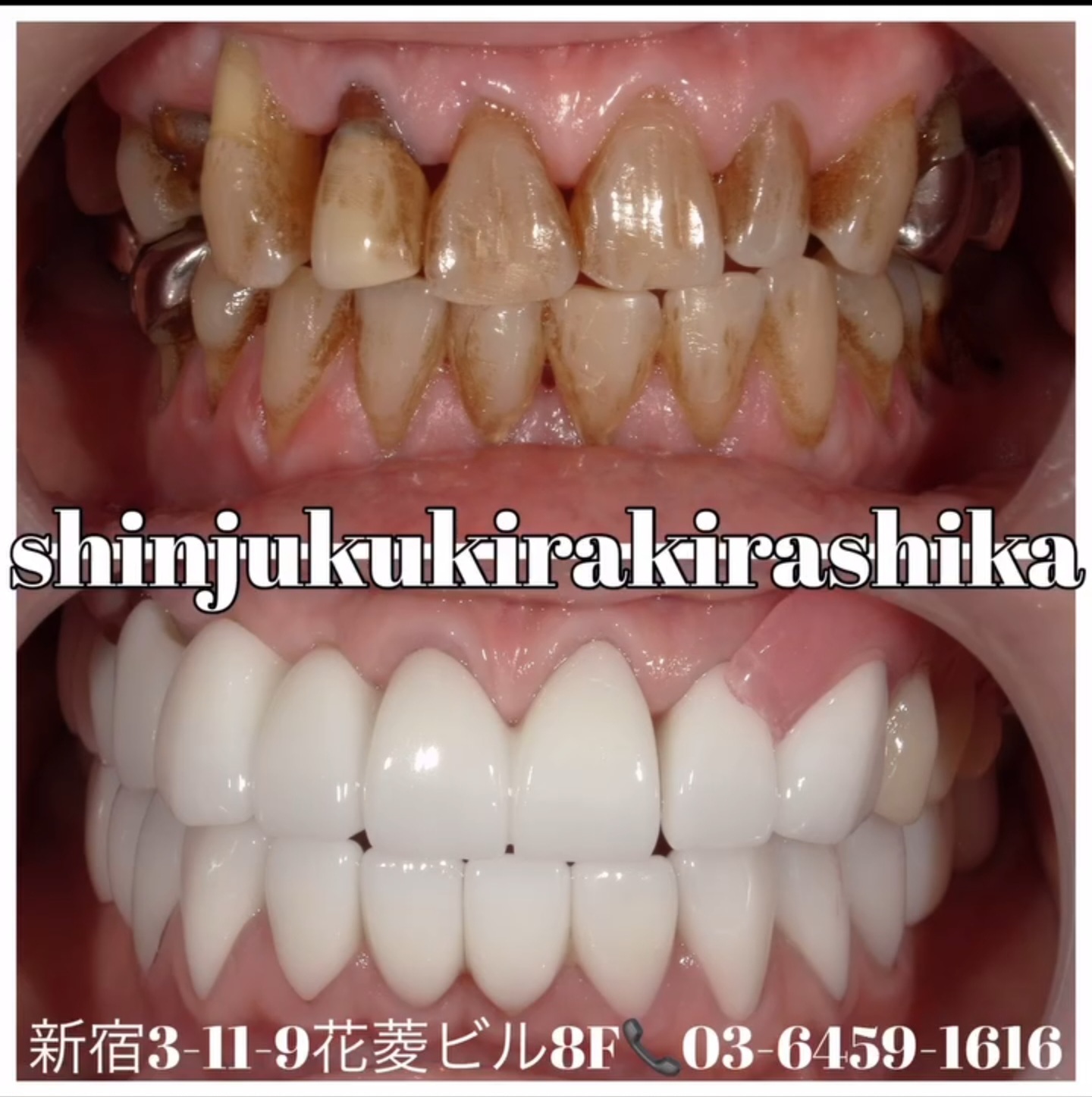 歯の色激変!!ジルコニア治療と義歯治療症例