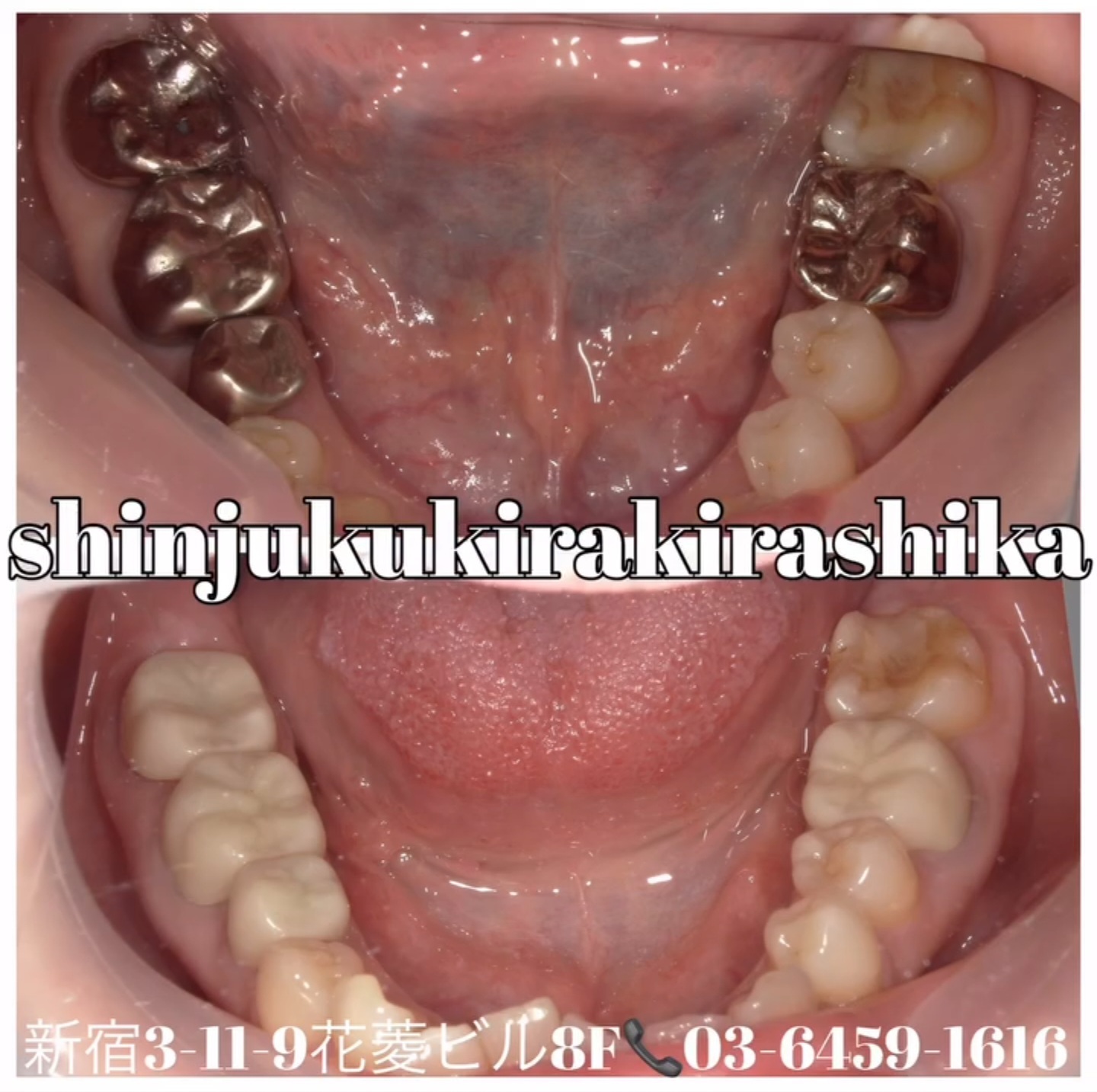 メタルフリー治療症例