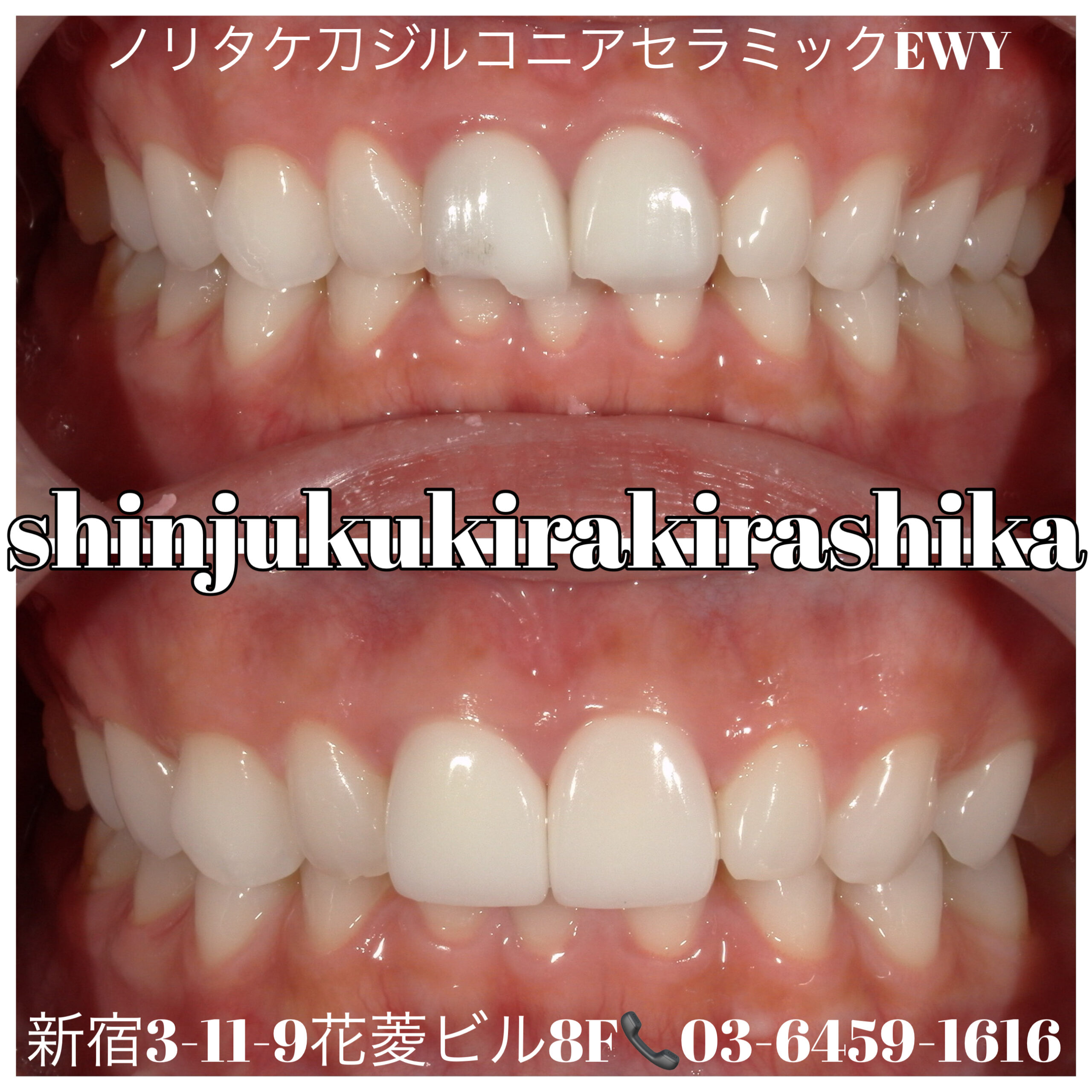 他院修正!セラミックがかけてしまった。