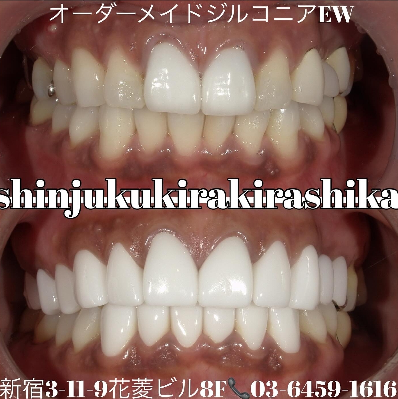 オーダーメイドジルコニア17本 色:EW