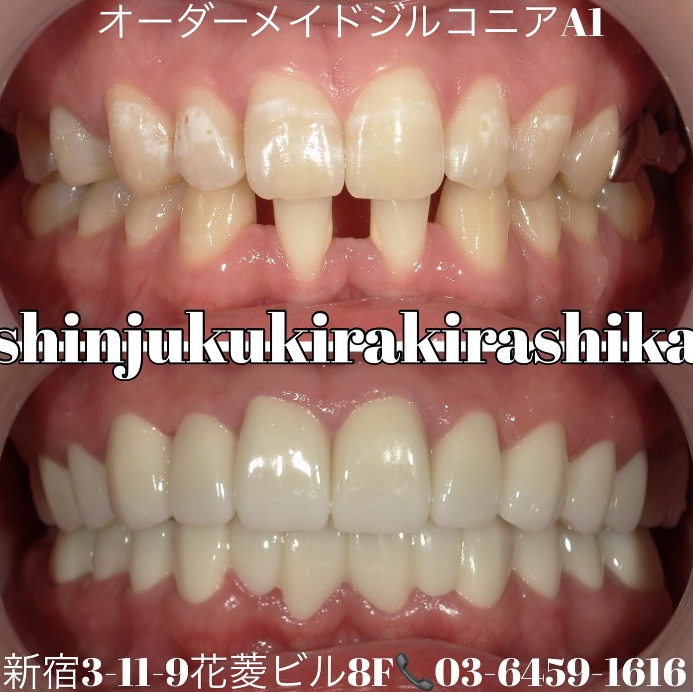 オーダーメイドジルコニア27本 色:A1