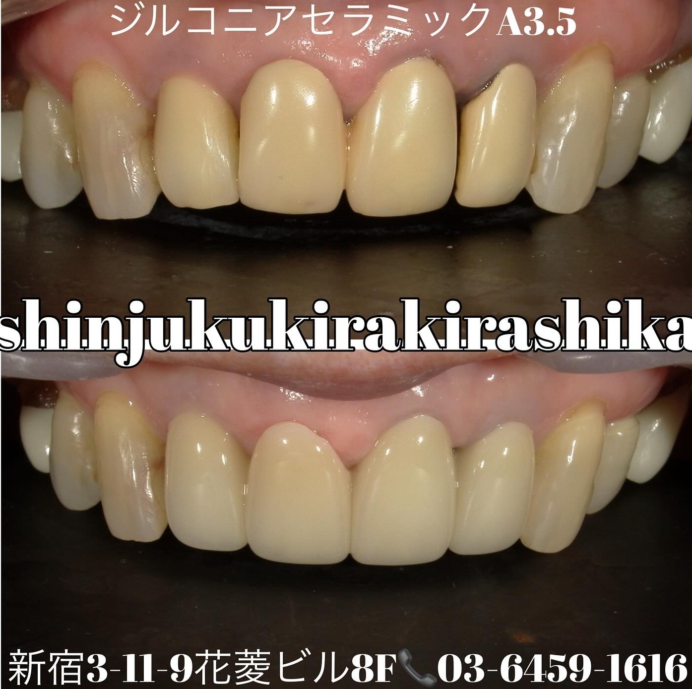 ジルコニアセラミック4本 色:A3.5