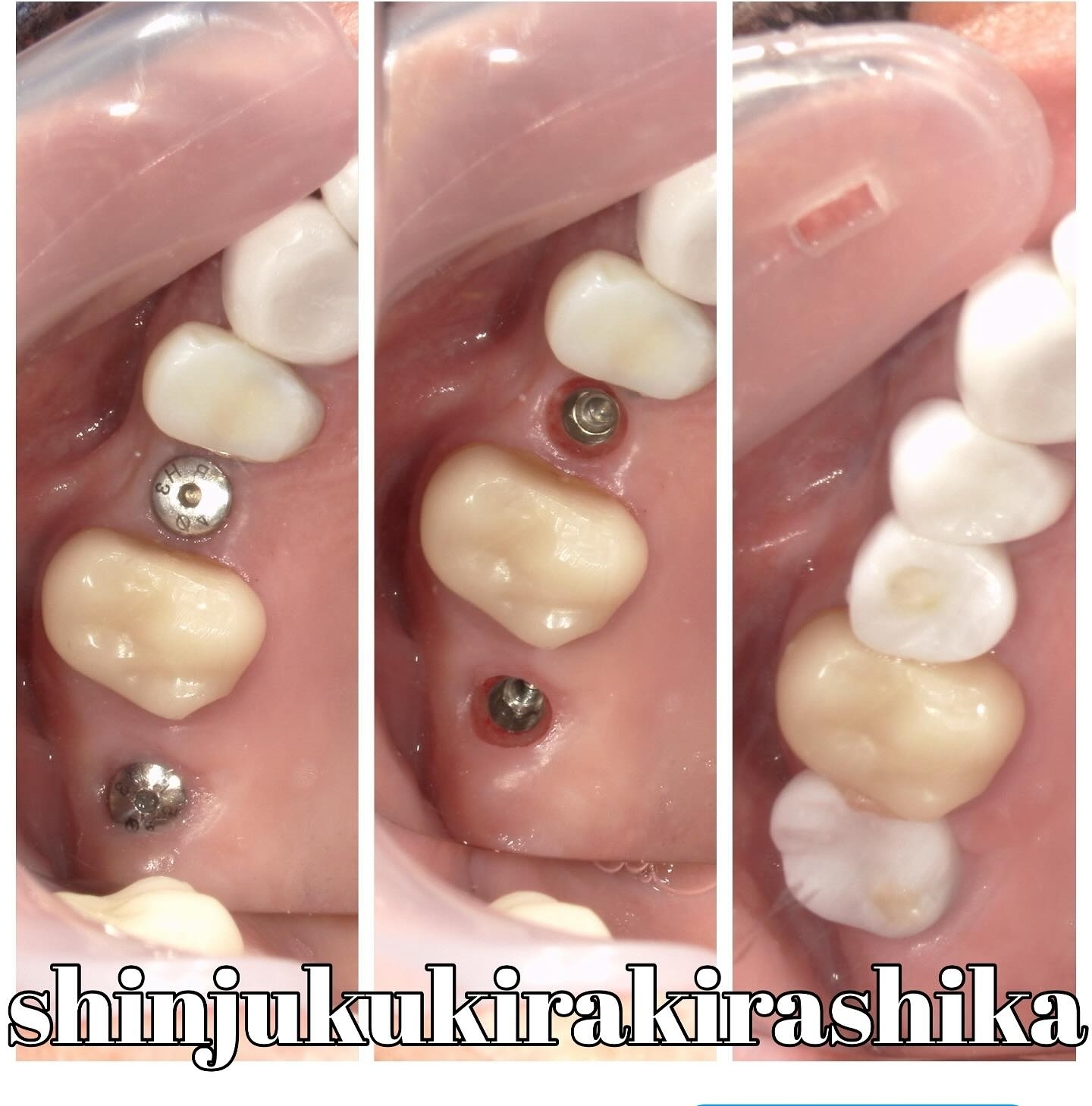 インプラント治療