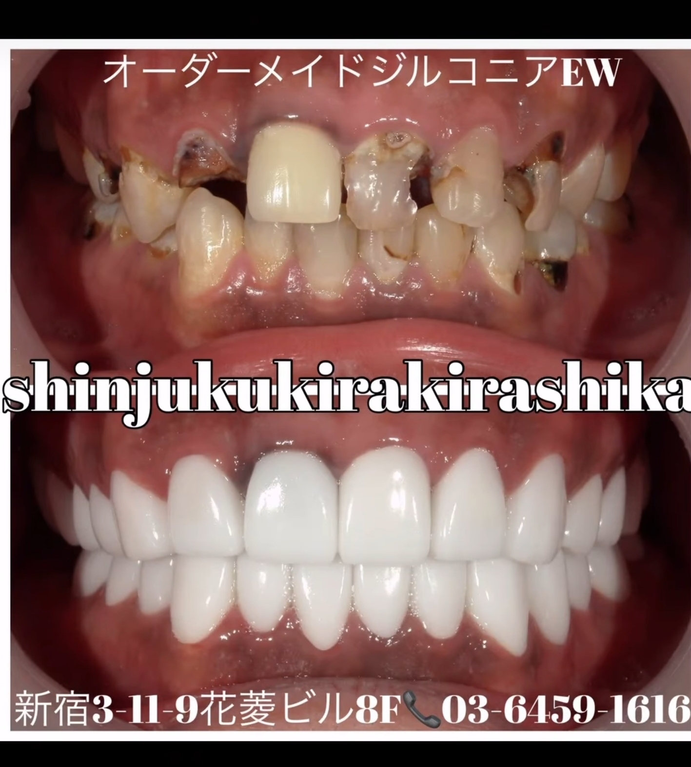 オーダーメイドジルコニア27本 色:EW