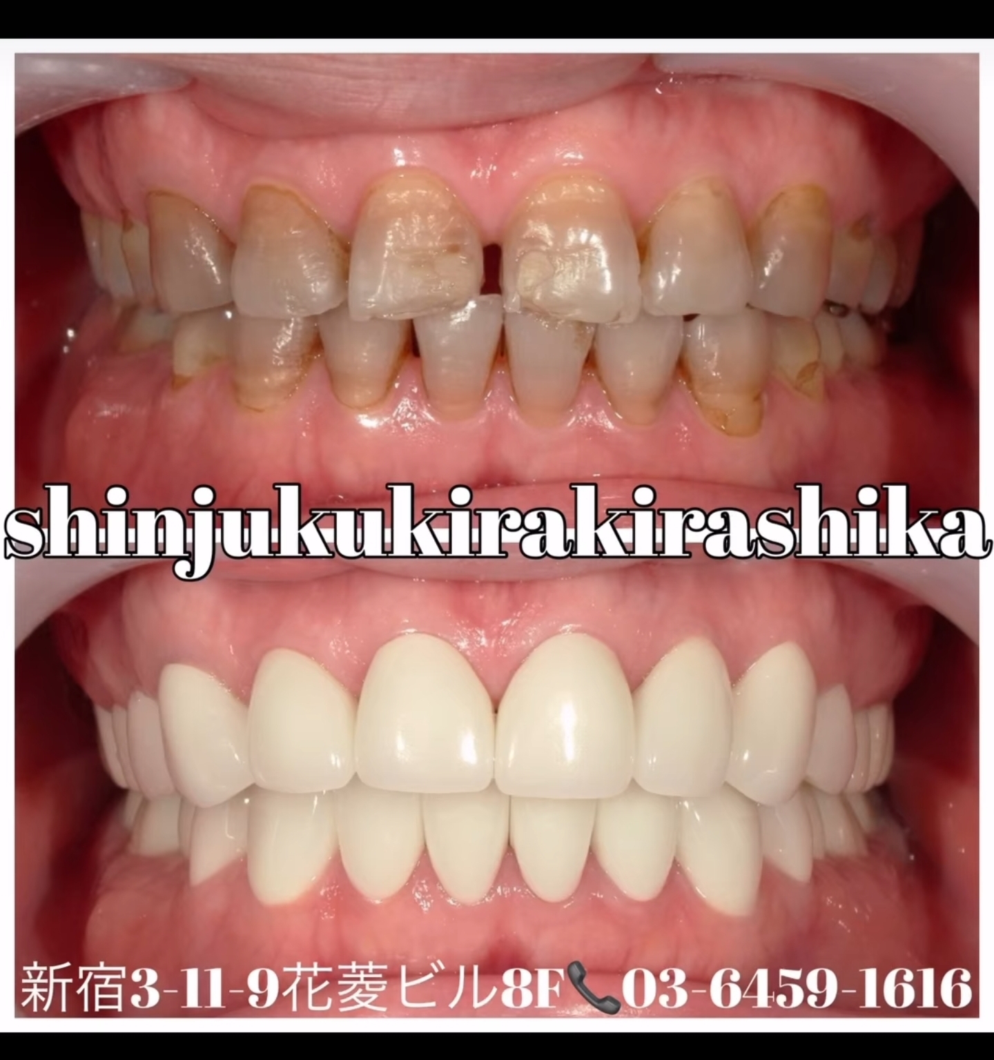 ジルコニアセラミック28本 色:A1