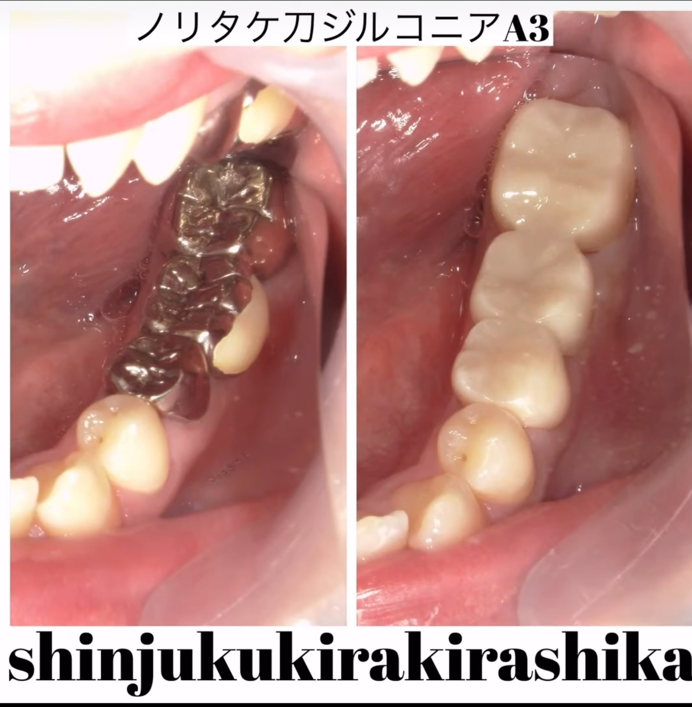 オーダーメイドジルコニア3本 色:A3