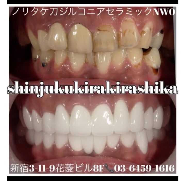 ジルコニアセラミック26本 色:NW0