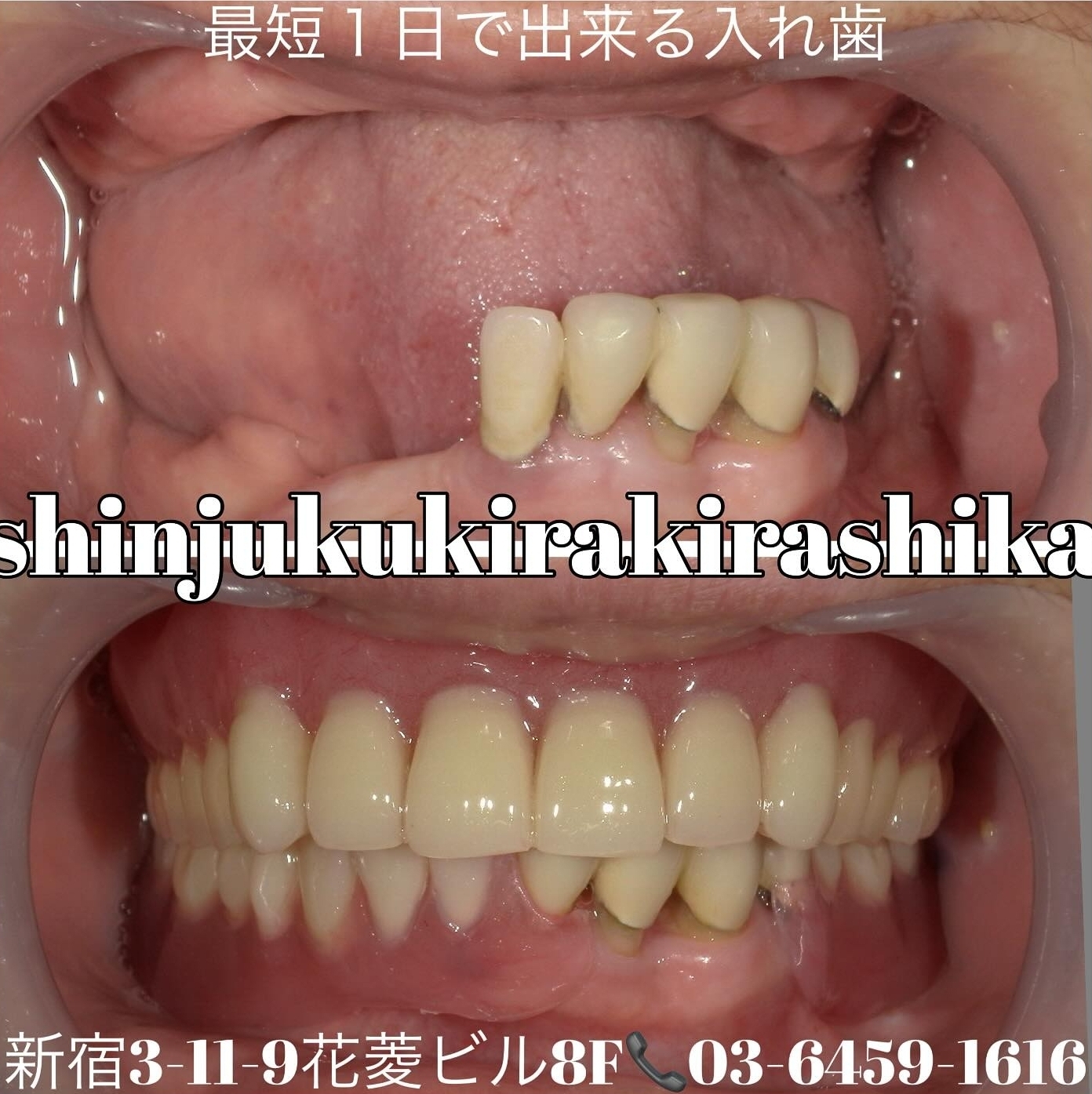 最短1日で出来る入れ歯