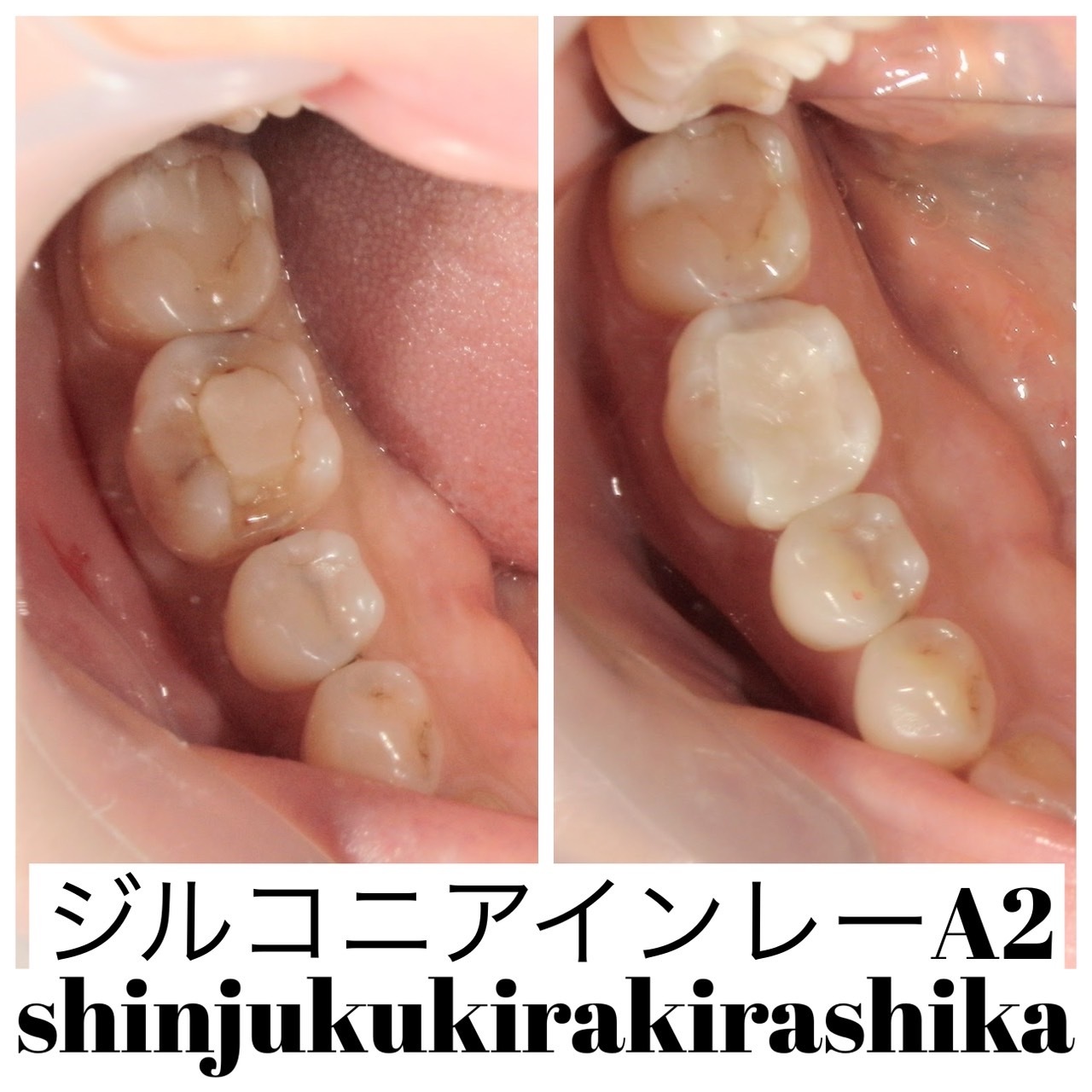 ジルコニアインレー 色:A2