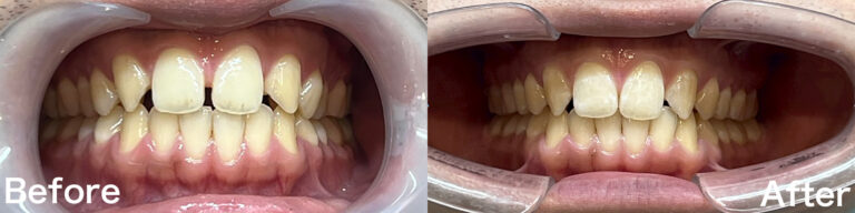 インビザラインgoによるすきっ歯の矯正治療